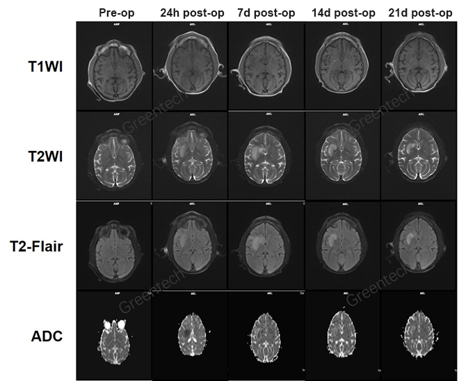 MRI scanning pre and post MCAO surgery.png